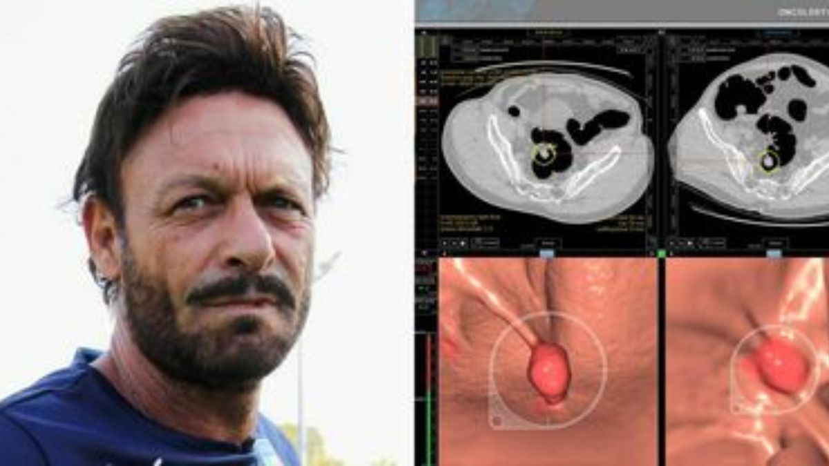 Totò Schillaci malato di tumore al colon: cos’è e come si previene